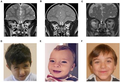 Olfactory Malformations in Mendelian Disorders of the Epigenetic Machinery